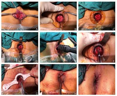 Outcomes of Modified Tissue Selection Therapy Stapler in the Treatment of Prolapsing Hemorrhoids